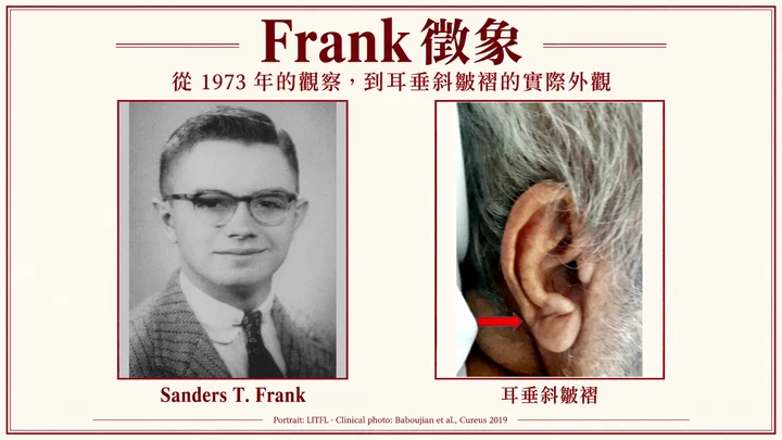 耳垂有斜皺褶＝心臟有問題？白話解讀 Frank 徵象的來源與可信度衛教插圖