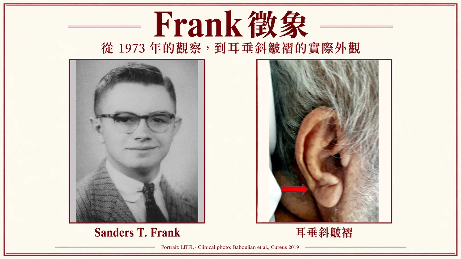 耳垂有斜皺褶=心臟有問題?白話解讀 Frank 徵象的來源與可信度衛教插圖