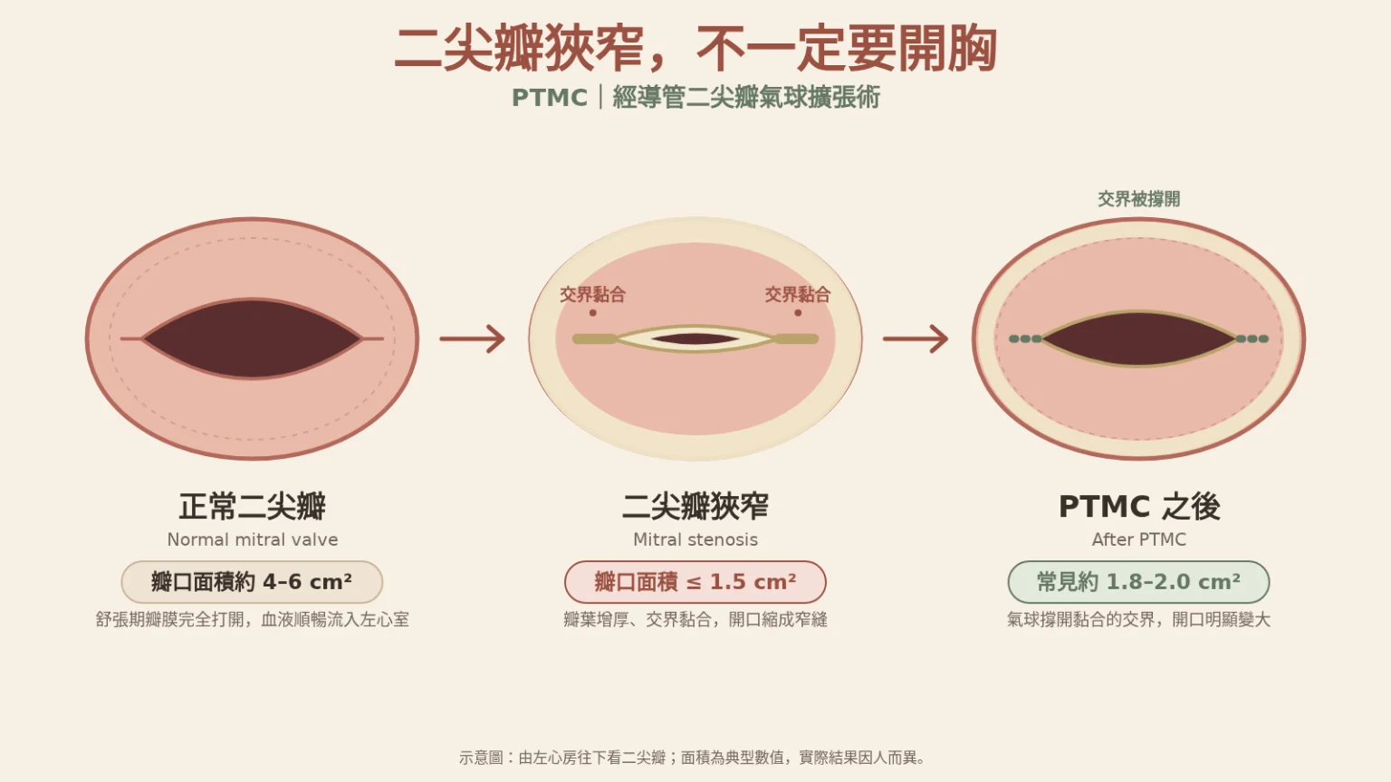 二尖瓣狹窄，非開刀的選擇：PTMC（經導管二尖瓣氣球擴張術）衛教插圖